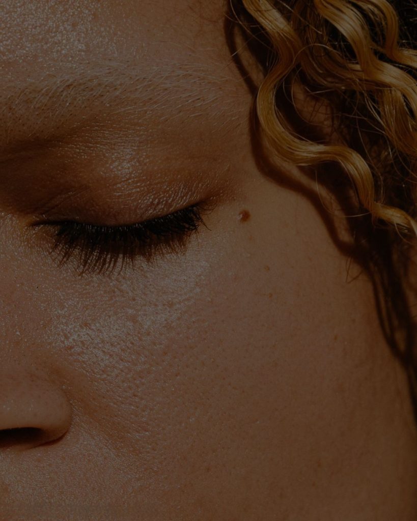 Sve što treba da znate o hiperpigmentaciji